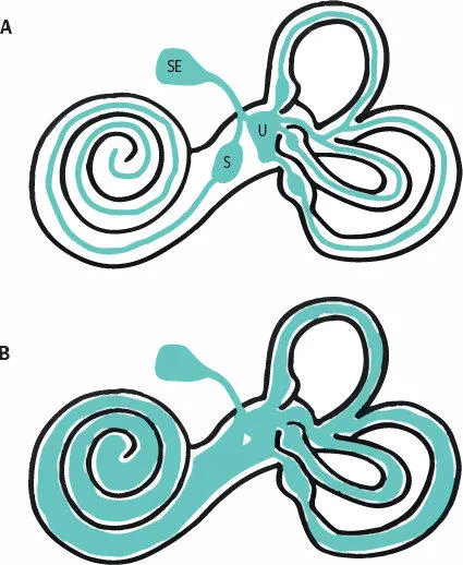 Diagramme montrant les différents symptômes associés à la maladie de Menière et l'hydrops endolymphatique.