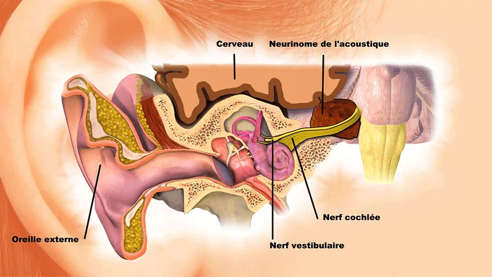 Planche d'illustration du neurinome de l'acoustique